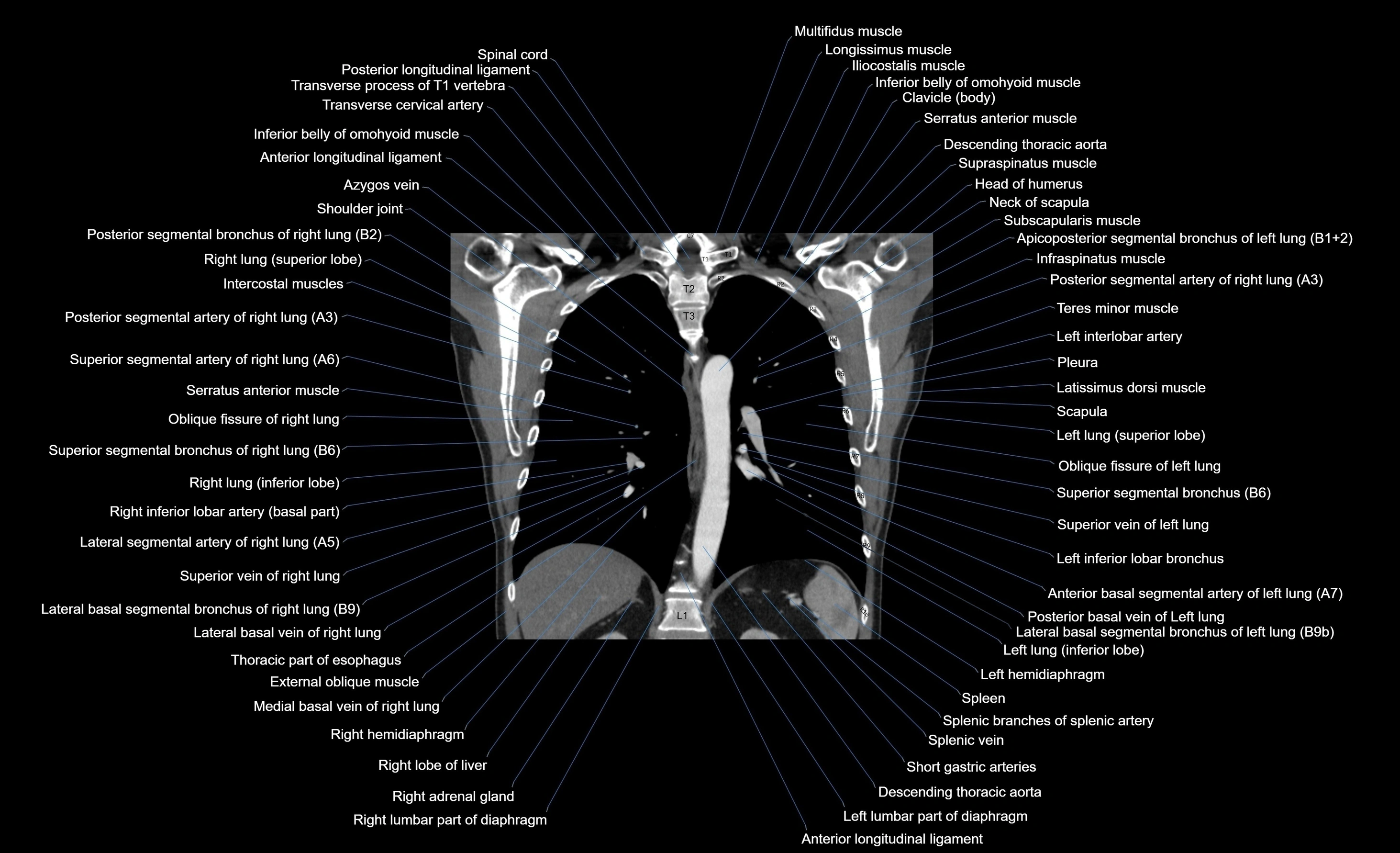 CT chest (thorax) soft tissue window labelled coronal cross sectional anatomy radiology image-00047.webp